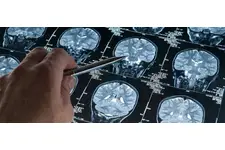 Alzheimer Tanısı Nelerdir?