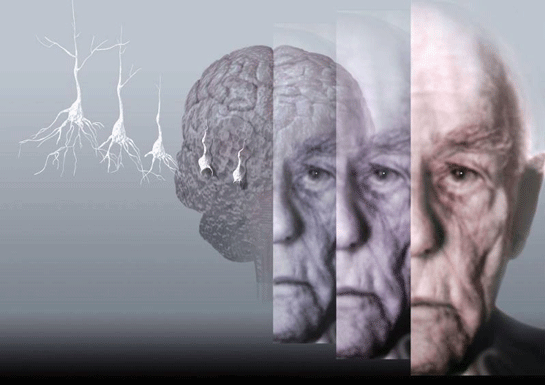 Alzheimer Tedavisi
